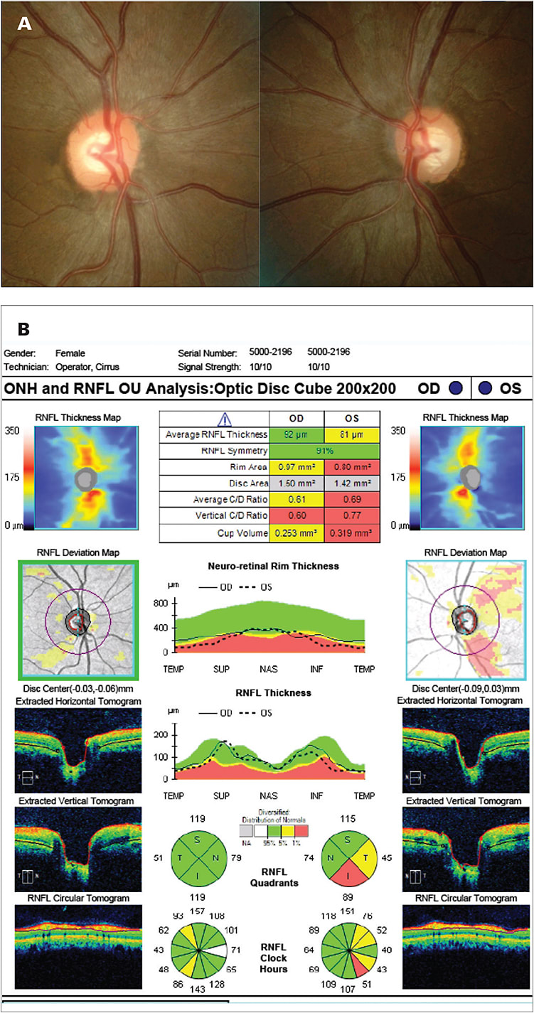 Figure 1. A 34-year-old female of Indian descent with no significant past medical or ocular history presents for glaucoma evaluation. She has a normal MRI of the brain and orbits. Over the past 9 years, she developed a progressive central scotoma OS with a corresponding wedge defect on the nerve fiber later. Figure 1A demonstrates the disc photos. Figure 1B demonstrates the baseline OCT data upon presentation.