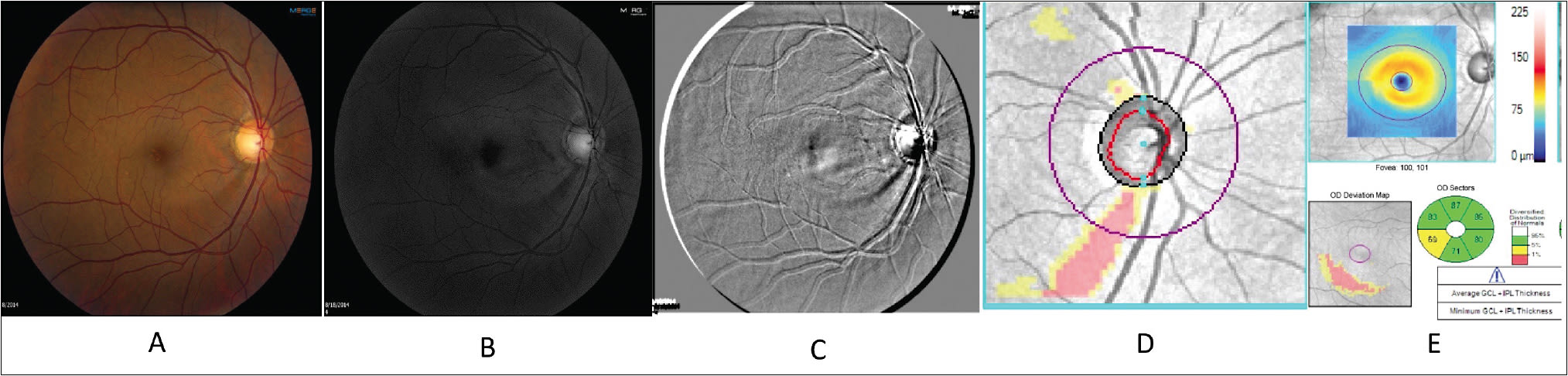 Figure 2. Digital filters during tele-glaucoma enhance retinal nerve fiber layer defect that is detected on OCT (A: Color image, B: Blue channel, C: Emboss filter, D: OCT RNFL defect, E: OCT posterior pole ganglion cell loss).