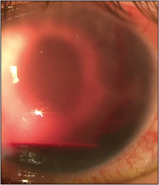 Figure 3. Hyphema on day 1 after 360° goniotomy, with layered hyphema, nasal clot, and circulating red blood cells.