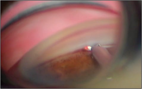 Figure 3. Surgeon’s view of first surgery with Goniotome +I/A. The tip is hovering in Schlemm canal and the TM is stretched onto the dual serrated blades and aspirated. Compared to an anterior-chamber maintained by viscoelastic, the view is clear and free of blood and debris.