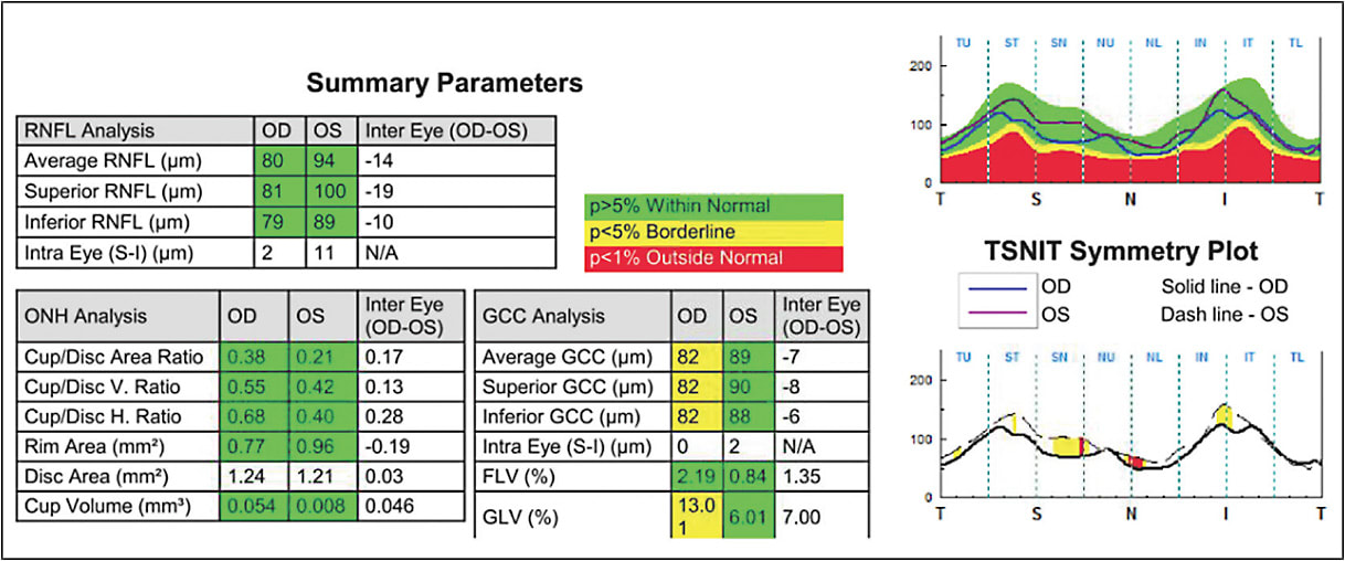 Figure 1. Summary parameters analyzing retinal nerve fiber layer, optic nerve head, and ganglion cell complex (AngioAnalytics; Optovue).