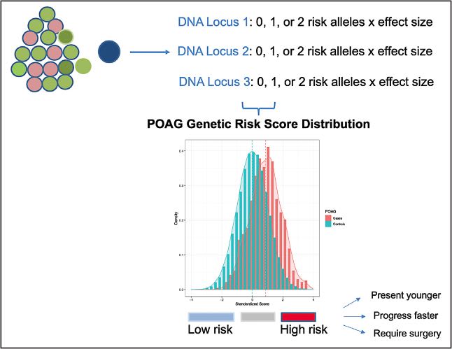 Figure 1. A patient sample consisting of cases and controls can be genotyped at various genetic loci associated with glaucoma. The genotype score is the sum of the risk alleles multiplied by the effect size for the gene effect. A plot of the genetic risk score will yield a bell curve, and cases are expected to have higher scores, although considerable overlap in scores is expected for a common complex disease like glaucoma. Cases with the highest scores may have the earliest disease onset, may have the fastest progression, and may be more likely to require surgery.