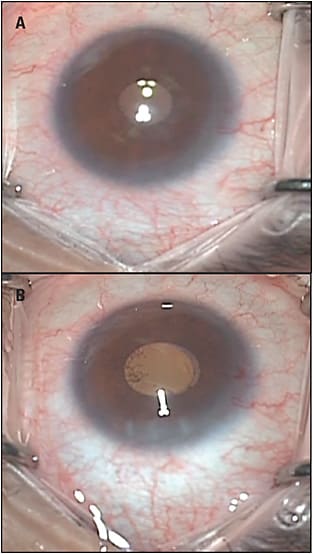 Figure 3. Immediately before (A) and after (B) ab-interno canaloplasty. Note blanching of the episcleral venous system following viscodilation.