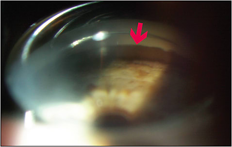 Figure 2. Gonioscopic photography reveals ciliary body tumor invasion and replacement of the angle structures. The tumor has also grown onto the corneal endothelium (arrow). Also, note pigment tumor dispersion onto the peripheral iris stroma. Figure courtesy Paul T. Finger, MD.