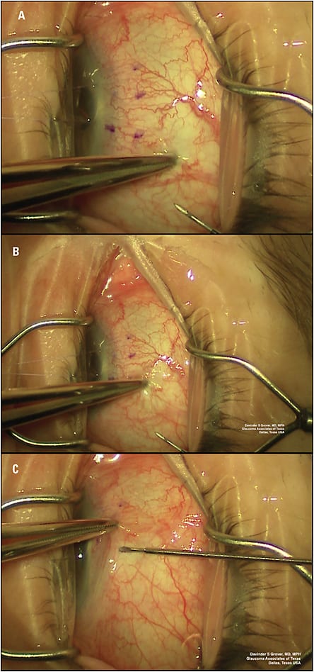 Figure 2. Intraoperative photograph demonstrating the movement and dragging of the superior temporal conjunctiva in the inferior nasal direction to ensure the conjunctival button hole is not located in the position of the Xen implant. Images A, B, and C show the movement of the forceps in chronological order.