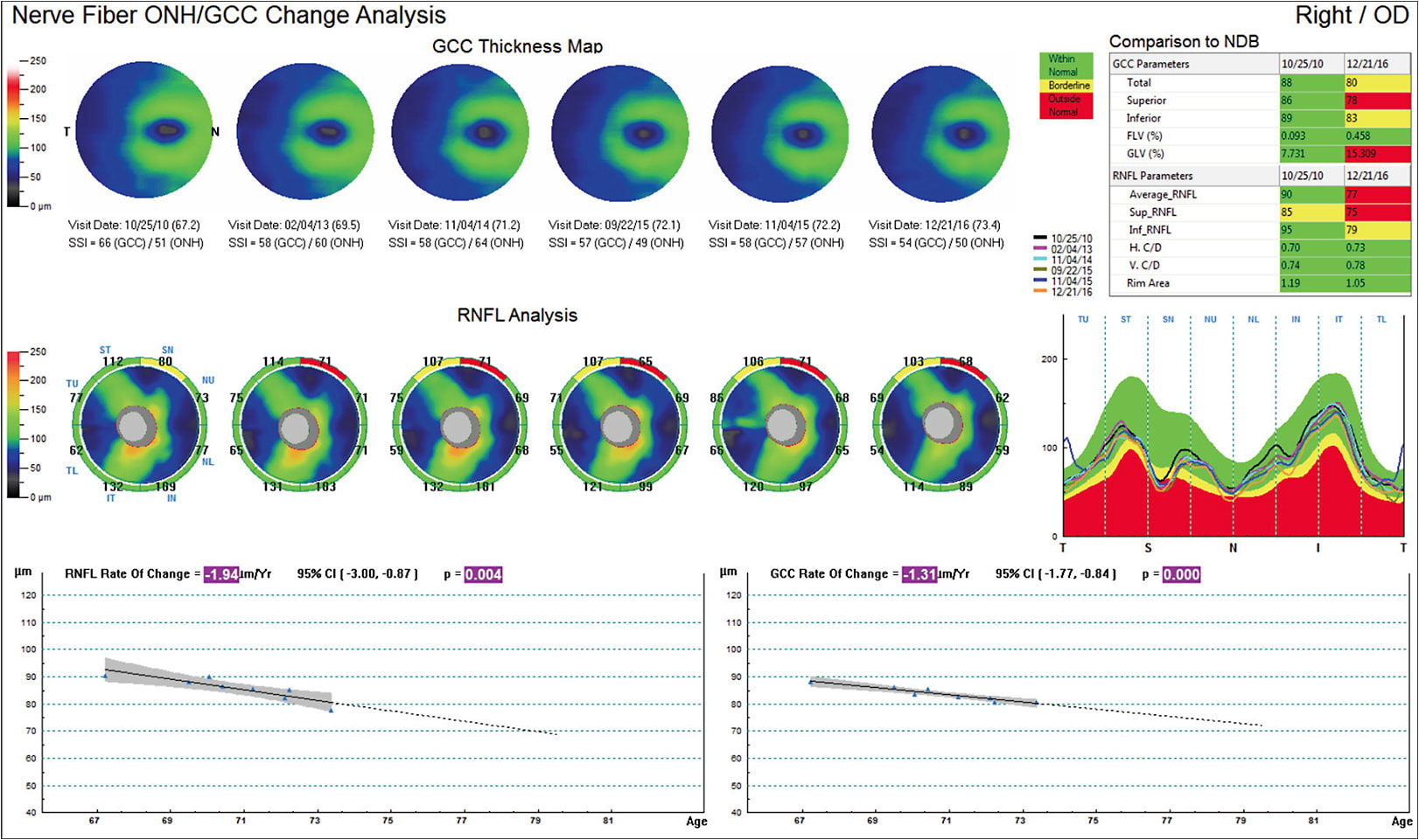 Figure 1. Case 1: trend analysis OD showed an RNFL rate of change of -1.94 µm/yr and a GCC rate of change of -1.31 µm/yr.