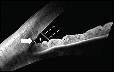 Figure 2. Spectral-domain optical coherence tomography of an open angle. The solid arrow points to the scleral spur. The line corresponding to the angle opening distance (AOD) 500, which extends from a point 500 μm anterior to the scleral spur to the opposing iris, is also displayed (dashed arrows). The trabecular iris space area (TISA) 500 is the area bounded by the AOD500 anteriorly, a line perpendicular to the inner scleral wall extending from the scleral spur to the iris posteriorly.