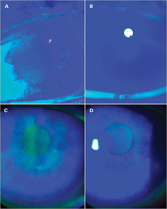 Figure 1. Significant corneal epitheliopathy induced by topical medications (A, C) and improved surface following MIGS (iStent; Glaukos) and discontinuation of medications (B, D).