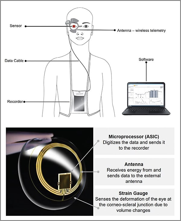 Figure 2. Diagram of a Triggerfish contact lens sensor and recording system (Sensimed).