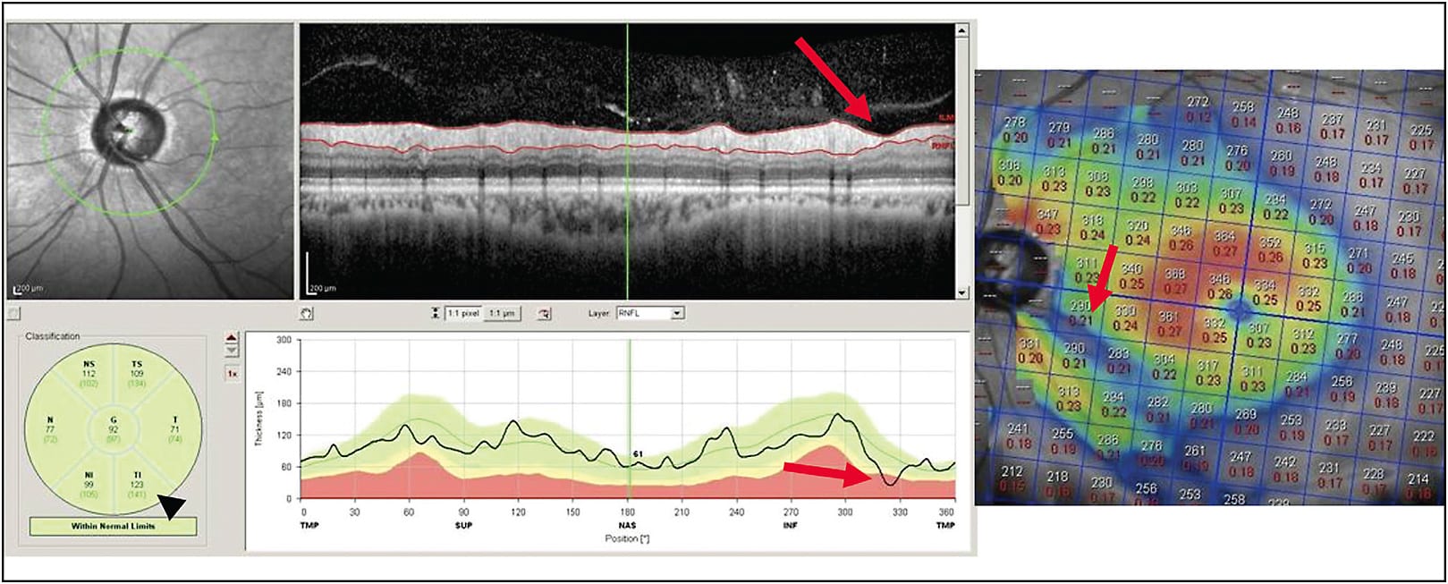 Figure 1. Example of “green disease” demonstrating normal average RNFL sectoral thickness (black arrowhead) masking evidence of focal RNFL thinning. This “pinching” is indicated on the circular scan, RNFL thickness plot, and macular thickness scan (red arrows).