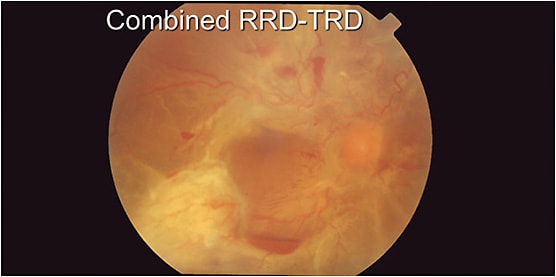 Figure 1: When repairing a combined rhegmatogenous and TRD, there is less counter-traction to pull the membranes. It is often difficult to visualize the breaks because they are under areas of fibrosis; but if there’s subretinal blood, it is assumed that there is a break somewhere, because in diabetes the neovascularization is epiretinal, not subretinal.