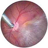 FIGURE 3: Endoscopic image of an eye undergoing air fluid exchange for treatment of macula-off retinal detachment. IMAGE COURTESY RUPAN K. TRIKHA, MD