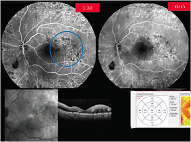 FIGURE 2: Focal laser for non-center-involving DME.