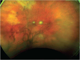 FIGURE 2. Three weeks after initiating treatment vitritis is improved, showing the large areas of active retinitis, superior and temporal. IMAGE COURTESY JESSICA WEINSTEIN, MD