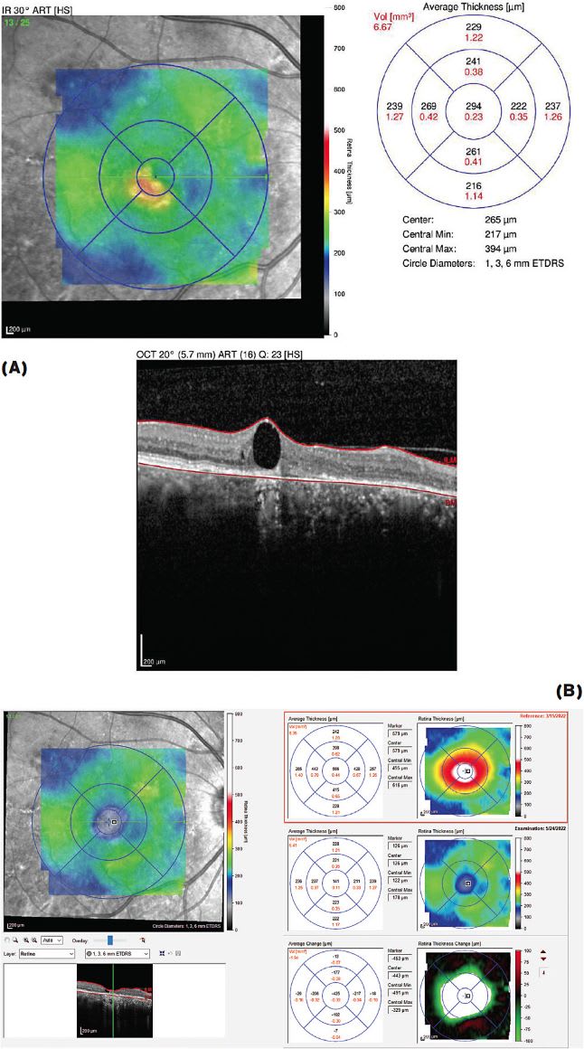 FIGURE 4: Upon confirming the success of Eylea treatment in the left eye, injections were initiated in the patient’s worse right eye (A). After 9 injections over 11 months, the patient’s visual acuity had significantly improved from 20/400 to 20/150, stabilizing at 20/250 (B). Note the difference in the right eye over the course of eight months. IMAGE COURTESY DAVID HUNT, MD, FACS