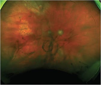 FIGURE 3. After 5 weeks of treatment, the retinitis is finally inactive and scarred. IMAGE COURTESY JESSICA WEINSTEIN, MD