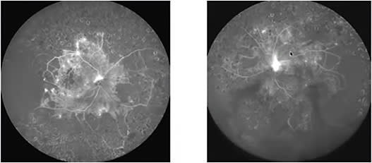 FIGURE 3: Resistant DME after multiple anti-VEGFs. Role of periphery evaluation in identifying why this edema is persistent even if you know that your patient has had PRP.