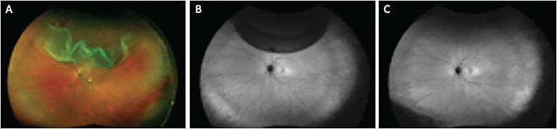 FIGURE 2: Patient case demonstrating a left macula off superior retinal detachment and a superior retinal break at 12 o’clock (A). Following the minimal gas vitrectomy (MGV) technique for retinal detachment repair, there is no evidence of retinal vessel printings on fundus autofluorescence imaging that would be suggestive of retinal displacement at the postoperative day 4 (B) and 1-month (C) follow-ups. The patient achieved a high integrity retinal attachment (HIRA).