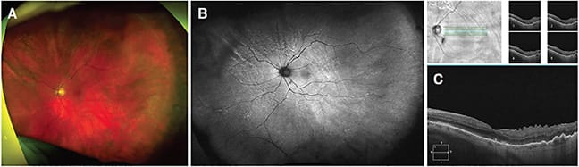 FIGURE 2: Multimodal imaging of the left eye at post-op year one visit: (A) Optos color fundus photo; (B) Optos autofluorescence revealing all the past resolved/resolving choroidal fold lines; (C) OCT 5-line raster scan of the macula depicting a flat macula with mild ERM, resolving ellipsoid zone changes, and choroidal folds.