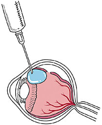 FIGURE 3: Intravitreal gas injection with the needle tip barely in the eye to inject the gas into an expanding gas bubble against the eye wall. This technique minimizes the risk of fish eggs.