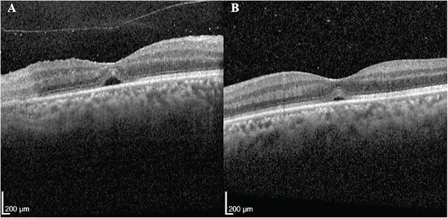 FIGURE 2. Ocular coherence tomography (OCT) images of macula of both eyes on initial presentation demonstrating (A) vitreous cells, full-thickness retinitis, and subfoveal fluid in the right eye and (B) vitreous cells and subfoveal fluid in the left eye. Images taken with Heidelberg Spectralis OCT system. IMAGES COURTESY VENKATKRISH M. KASETTY, MD; DHRUV SETHI, MD, MBA, MPH; AND EVGENY GELMAN, MD.