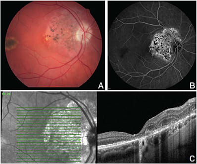 FIGURE 2: At follow-up visit, more than two years following the initial presentation, fundus examination of the right eye revealed stabilization and scarring of the choroidal neovascular membrane (A). No further leakage was noted on fluorescein angiography (B) and optical coherence tomography (en face and cross-sectional) showed consolidation of the choroidal neovascular membrane into an inactive scar (C).IMAGES COURTESY RAY MOK