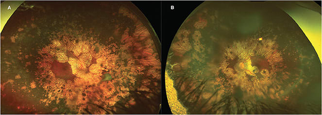 FIGURE 2: Optos ultrawidefield images of the right eye (A) and left eye (B) show symmetric advanced peripheral chorioretinal atrophy with scalloped margins involving the macula. IMAGE COURTESY WEI CHEN LAI, BS