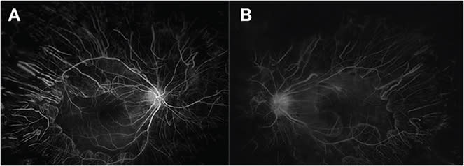 FIGURE 3: Optos ultrawidefield fluorescein angiograph images of the right eye (A) and left eye (B) showing symmetric bilateral significant peripheral window defects of choroidal vasculature corresponding to the peripheral chorioretinal atrophy. There is also bilateral mild disc and macular leakage. IMAGE COURTESY WEI CHEN LAI, BS