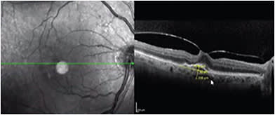 FIGURE 5: DME can be tractional, vascular, and comorbid pathology (CNV) at the same time.