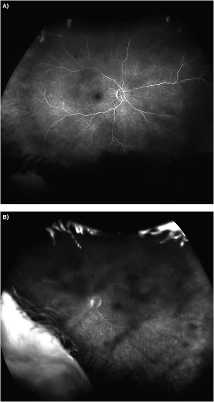 FIGURE 3. (A) Widefield fluorescein angiogram of the right eye affected by blockage from vitritis but without any significant leakage. (B) Widefield fluorescein angiogram of the left eye affected by blockage from vitritis but without any significant leakage.