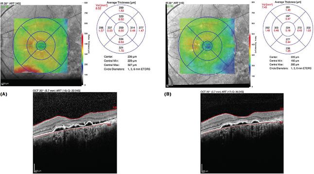 FIGURE 3: Injections of aflibercept (Eylea; Regeneron) were initiated in the left eye (A), because it possessed higher visual acuity and less severe edema. One month after receiving the first Eylea injection, the patient began to display improvement, as seen in the OCT heat map (B). IMAGE COURTESY DAVID HUNT, MD, FACS