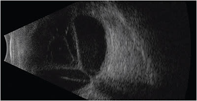 FIGURE 5: B-scan ultrasonography of the right eye demonstrates closed funnel retinal detachment with thin retina and preretinal proliferative membranes. IMAGE COURTESY MICHELLE DUBOIS AND PHILLIP TURNER