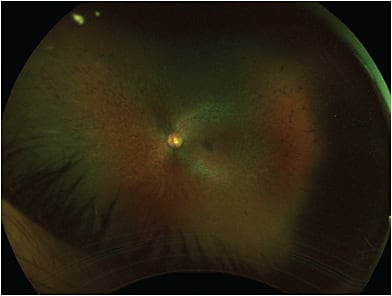 FIGURE 2: Fundus photo of the left eye. Similar to the right eye, there are numerous bone spicules. The RPE and retinal atrophy within the retinal periphery and macula appears to be more advanced.