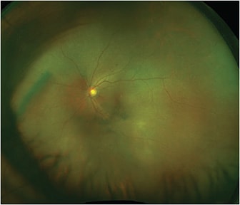 FIGURE 1: An ultrawidefield fundus photograph of the left eye shows vitreous cell and debris and white subretinal lesions most prominent in the inferotemporal macula. IMAGE COURTESY MUSA ABDELAZIZ, MD