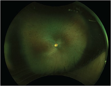 FIGURE 1: Fundus photo of the right eye. There are numerous bone spicules as well as RPE and retinal atrophy within the retinal periphery and macula.