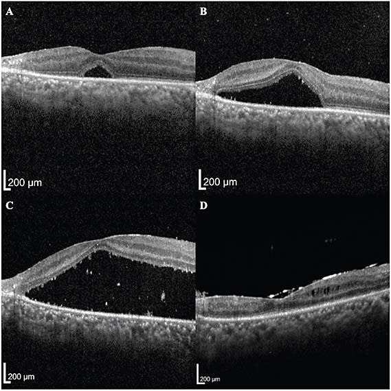 FIGURE 3. Macula of the right eye 4 weeks after initial presentation (A) reveals worsening subretinal fluid (SRF). Six weeks after initial presentation (B) demonstrates worsening SRF. Two months after initial presentation (C) demonstrates detached retina prior to PPV. Four months after PPV (D) demonstrates a necrotic attached retina, epiretinal membrane, and mild intraretinal cysts. IMAGES COURTESY VENKATKRISH M. KASETTY, MD; DHRUV SETHI, MD, MBA, MPH; AND EVGENY GELMAN, MD.