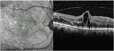 FIGURE 3: Tractional DME.