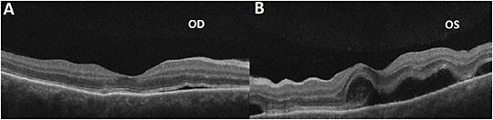 FIGURE 1: Optical coherence tomography (OCT) macula scans of 50-year-old female Asian patient on day 1 demonstrate multifocal lobular serous detachments, RPE detachments, and thickened choroid in both eyes (A, B). IMAGE COURTESY TIMOTHY S. LEE