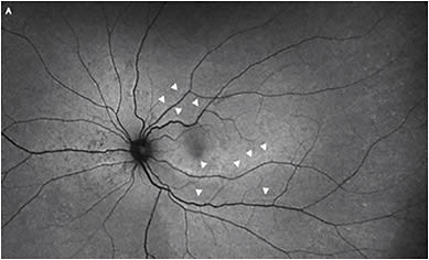 FIGURE 1: Fundus autofluorescence imaging following pars plana vitrectomy demonstrating a low integrity retinal attachment (LIRA) with substantial inferior retinal displacement.