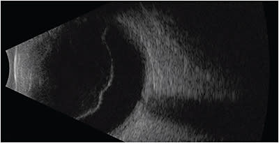 FIGURE 6: B-scan ultrasonography of the left eye demonstrates posterior vitreous detachment, lifted to the mid-vitreous, with moderate vitreous opacities and attached retina within field of view. The hyaloid face is highly reflective, which is echographically suggestive of layered opacities. IMAGE COURTESY MICHELLE DUBOIS AND PHILLIP TURNER