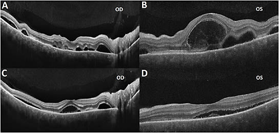 FIGURE 3: OCT scans on day 2 reveal new cystoid macular edema and bacillary layer detachments in both eyes (A, B). OCT scans on day 8 demonstrate improvements in previous findings after initiation of topical and systemic steroids (C, D). IMAGE COURTESY TIMOTHY S. LEE