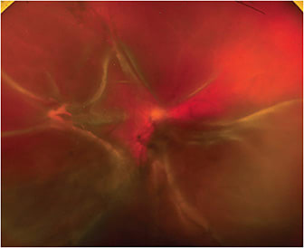 FIGURE 4. After 2 months of treatment, patient returns with a total retinal detachment. Tear is at the border of scarred area of prior retinitis. IMAGE COURTESY JESSICA WEINSTEIN, MD