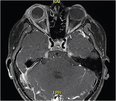 FIGURE 3: MRI orbits of 7-year-old patient show leptomeningeal metastases and right diffuse choroidal/subretinal involvement, and likely extension along the right distal intraorbital optic nerve sheath. (Protrusion and enhancement of the left optic disc is not seen in this view.) IMAGE COURTESY ALANNA JAMES, MD