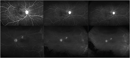 Figure 1: Fluorescein angiography showing leakage of the right optic nerve with multiple areas of punctate hyperfluorescence with late leakage OD&gt;OS. Hazy view of left eye secondary to progression of cataract after vitrectomy, late macular leakage is appreciable at OS.