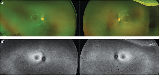 FIGURE 1. (A) Fundus photos of both eyes; (B) fundus autofluorescence. Note the inferior bone spicules and with hypopigmented flecks inferiorly in both eyes, which correspond to the inferior hypofluorescence seen on autofluorescence.