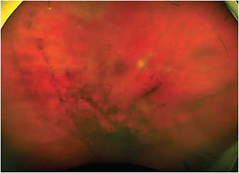 FIGURE 1. Fundus photo of the right eye with dense vitritis, 2+ haze, and several ill-defined yellowish scalloped lesions, superior and temporal. Note arteritis and sheathing at nasal arcade vessels. IMAGE COURTESY JESSICA WEINSTEIN, MD