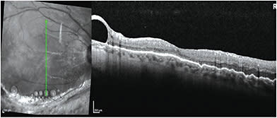 FIGURE 1: Subperipheral macula PFO which was managed by observation only.IMAGE COURTESY OF CARL REGILLO, MD.