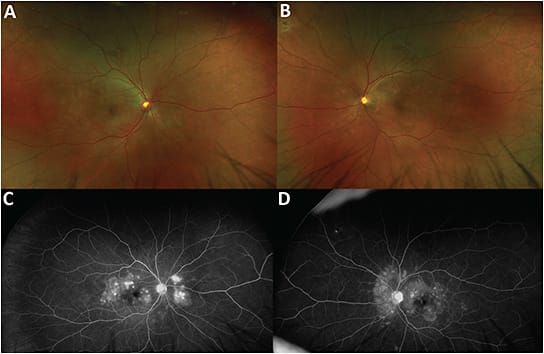 FIGURE 2: Optos ultrawidefield fundus photos (A, B) and fluorescein angiography (C, D) on day 1 show creamy-like, subretinal multifocal lesions in the posterior pole of both eyes. These correspond to hypoautofluorescence and early punctate subretinal choroidal staining pattern in the posterior pole with early staining and late pooling in a multifocal fashion. IMAGE COURTESY TIMOTHY S. LEE