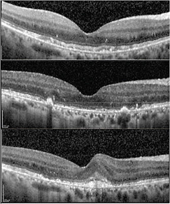 FIGURE 2: This image of the same patient shows the onset of choroidal neovascularization (CNV) in the contralateral eye. Over the course of 6 months the patient developed CNV and further vision loss. The top image was taken at first presentation, the second at 4 months following the onset of CNV, and the bottom image at 6 months following CNV onset. IMAGE COURTESY ZACK OAKEY, MD