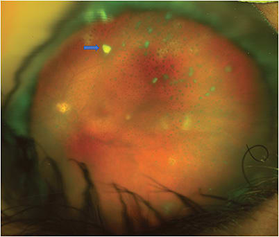 FIGURE 2: Optos widefield fundus image of the left eye demonstrating vitreous haze and snowballs with optic disc cupping, complete posterior vitreous detachment with Weiss ring, and discrete areas of retinal whitening concerning for retinal infiltrative lesions (arrow). IMAGE COURTESY BETH SNODGRASS